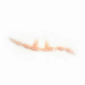 Out of Kit Split Keloid Scar
