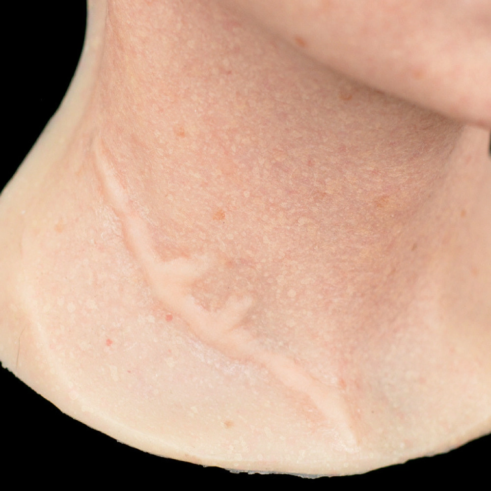 Out of Kit Split Keloid Scar