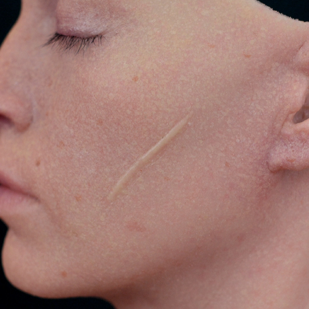Out of Kit Subtle Scar